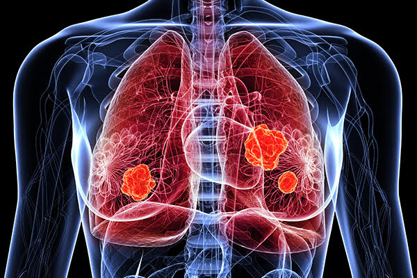 生物標誌物檢測 Biomarker Testing 有效診斷肺癌